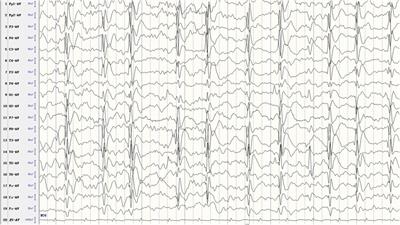 Exploratory analysis of high-dose corticosteroid therapy on epileptic encephalopathy with spike-and-wave activation in sleep